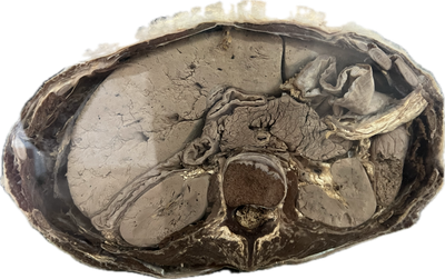 Corte Axial de Abdomen a Nivel de L2-L3