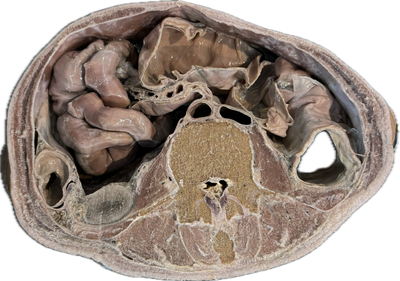 Corte Axial Abdominopélvico Nivel de L5-S1