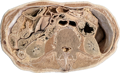 Corte Axial de Abdomen a Nivel de L3-L4