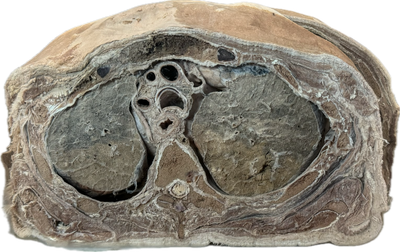 Corte Axial de Tórax a Nivel de T2-T3