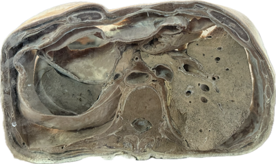 Corte Axial de Abdomen a Nivel de L2-L3