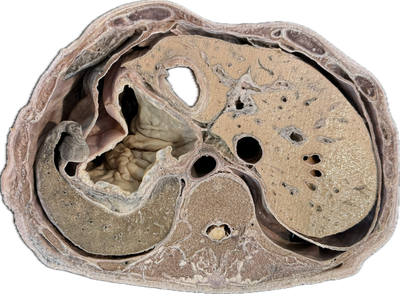Corte Axial de Abdomen a Nivel de L1-L2