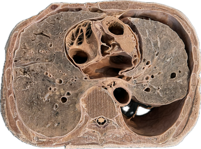 Corte Axial de Tórax a Nivel de T4-T5