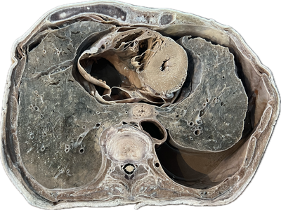 Corte Axial de Tórax a Nivel de T6-T7