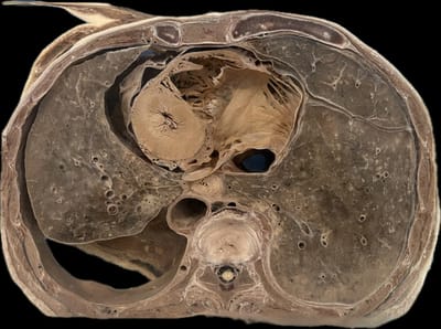 Corte Axial de Tórax a Nivel de T9-T10