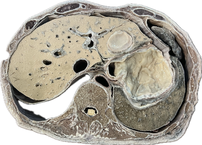 Corte Axial de Tórax a Nivel de T10-T11