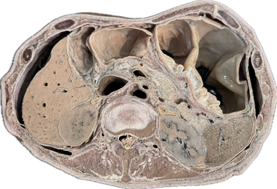 Corte Axial de Abdomen a Nivel de L1-L2