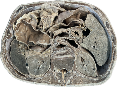 Corte Axial de Abdomen a Nivel de Disco Intervertebral de L2-L3 a L4
