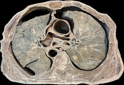 Corte Axial de Tórax a Nivel de T3-T4