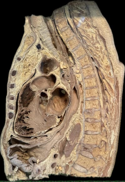 Corte Parasagital de Tórax