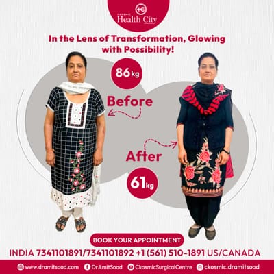 Most Common Myths and Facts About Mini Gastric Bypass Surgery