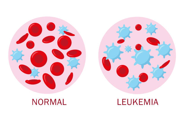 LEUKEMIA