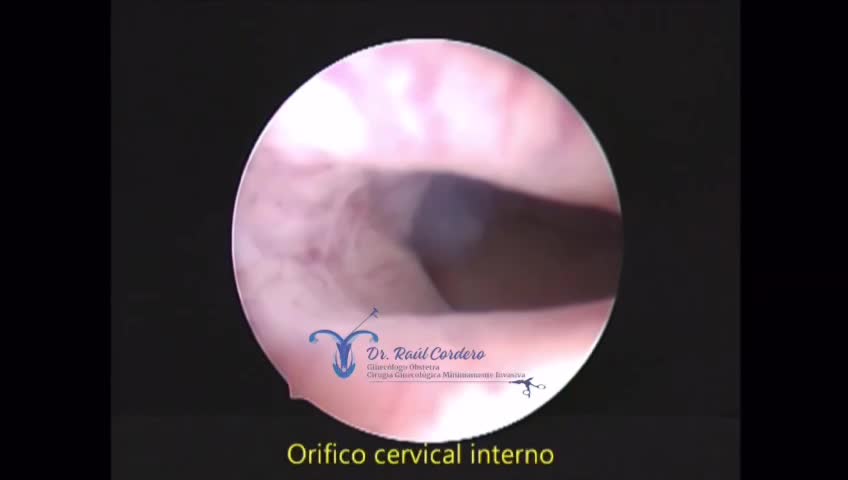 HISTEROSCOPIA DIAGNÓSTICA, CAVIDAD ENDOMETRIAL NORMAL