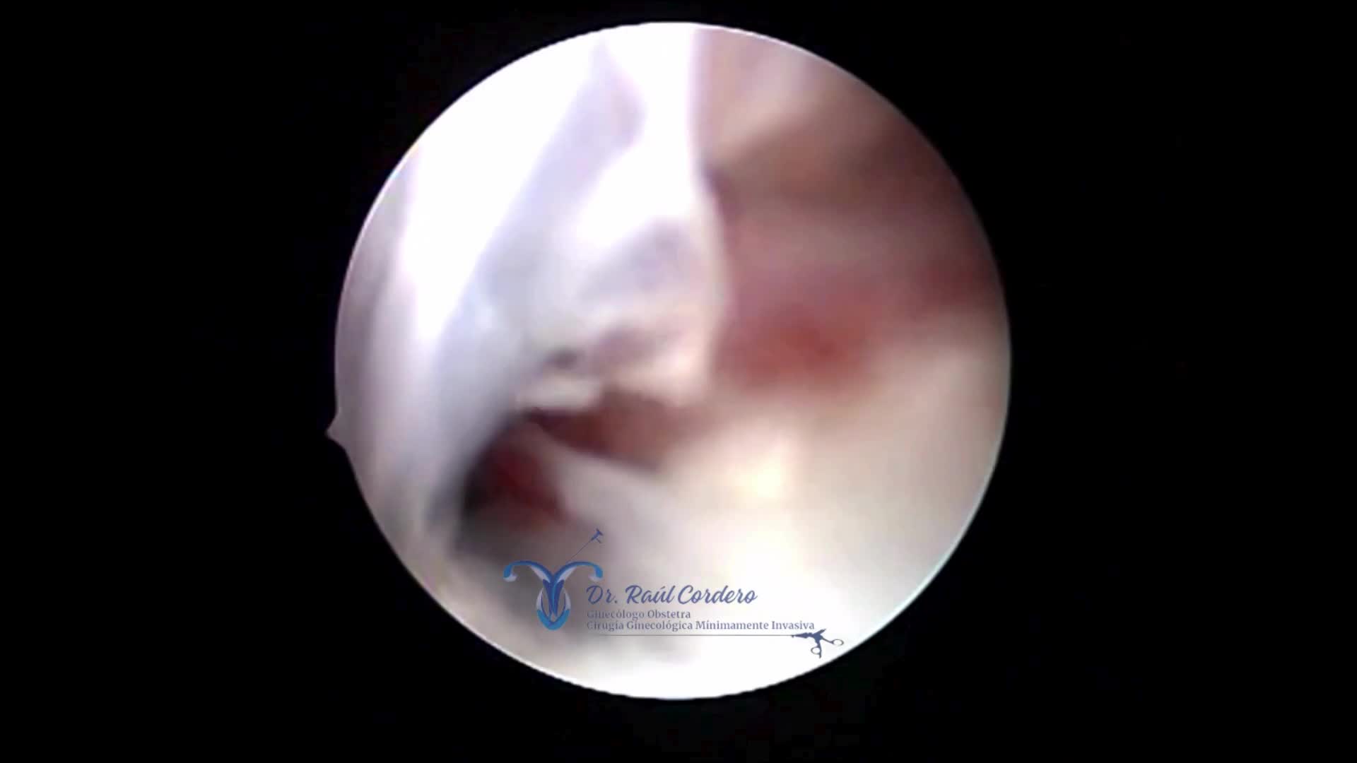 HEMATOMETRA POR VÍDEO HISTEROSCOPIA