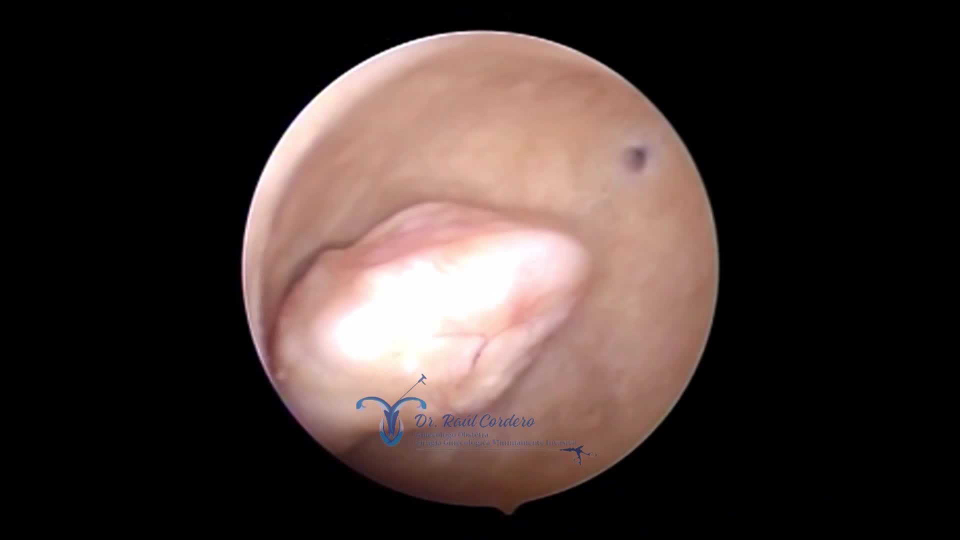 VÍDEO HISTEROSCOPIA DE PÓLIPO ENDOMETRIAL ÚNICO EN POSTMENOPAUSIA