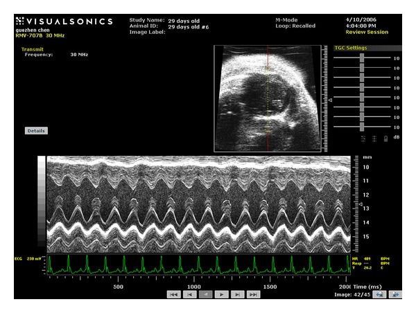 Chemotherapy Induced Heart Failure