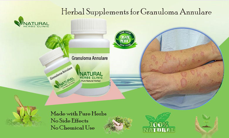 Best-Treatment-for-Granuloma-Annulare