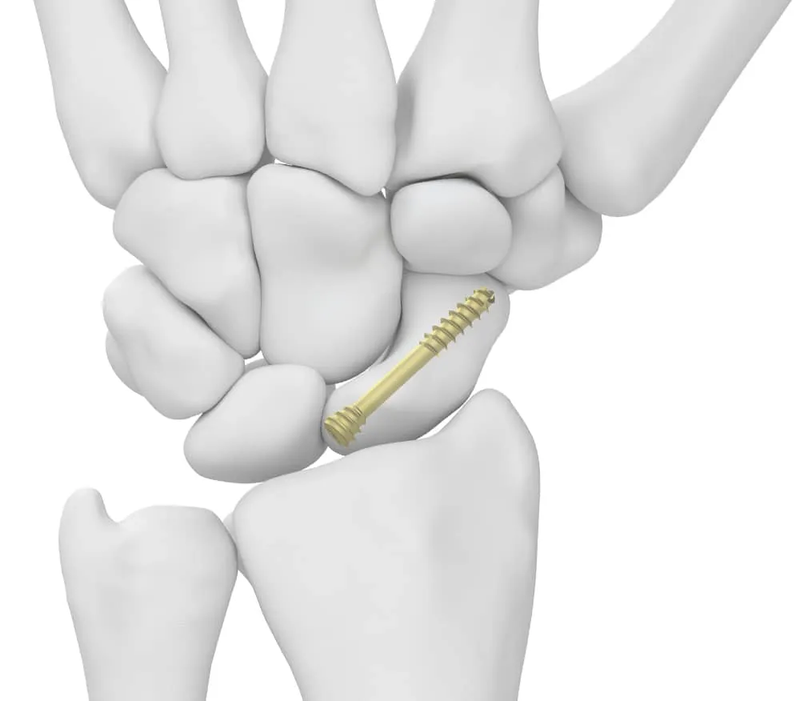 שבר וחוסר חיבור בעצם הסירה (Scaphoid Fracture & Scaphoid Nonunion)