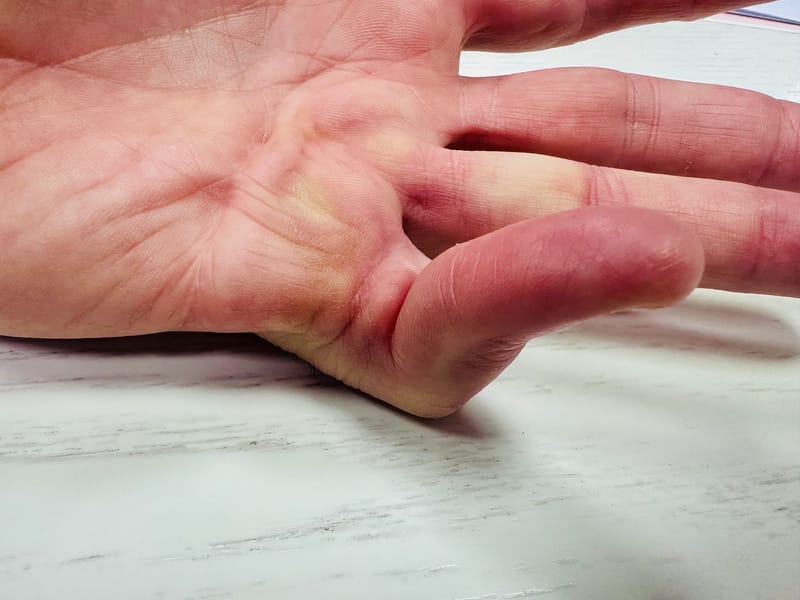 דופויטרן (Dupuytren's Contracture)
