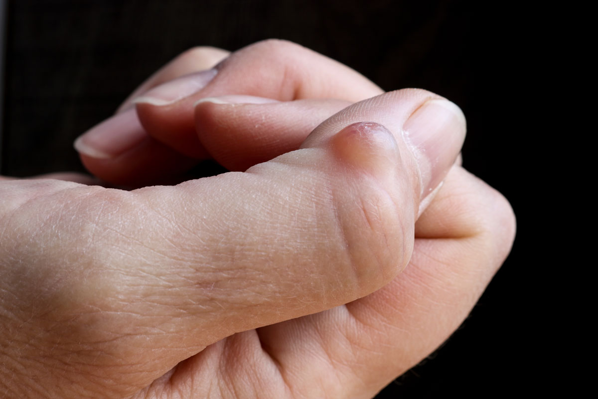 Ganglion Cyst Removal Tacoma | Dr. Dehghan | Artistic Plastic