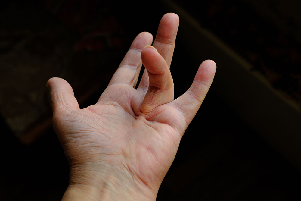 Dupuytren contracture
