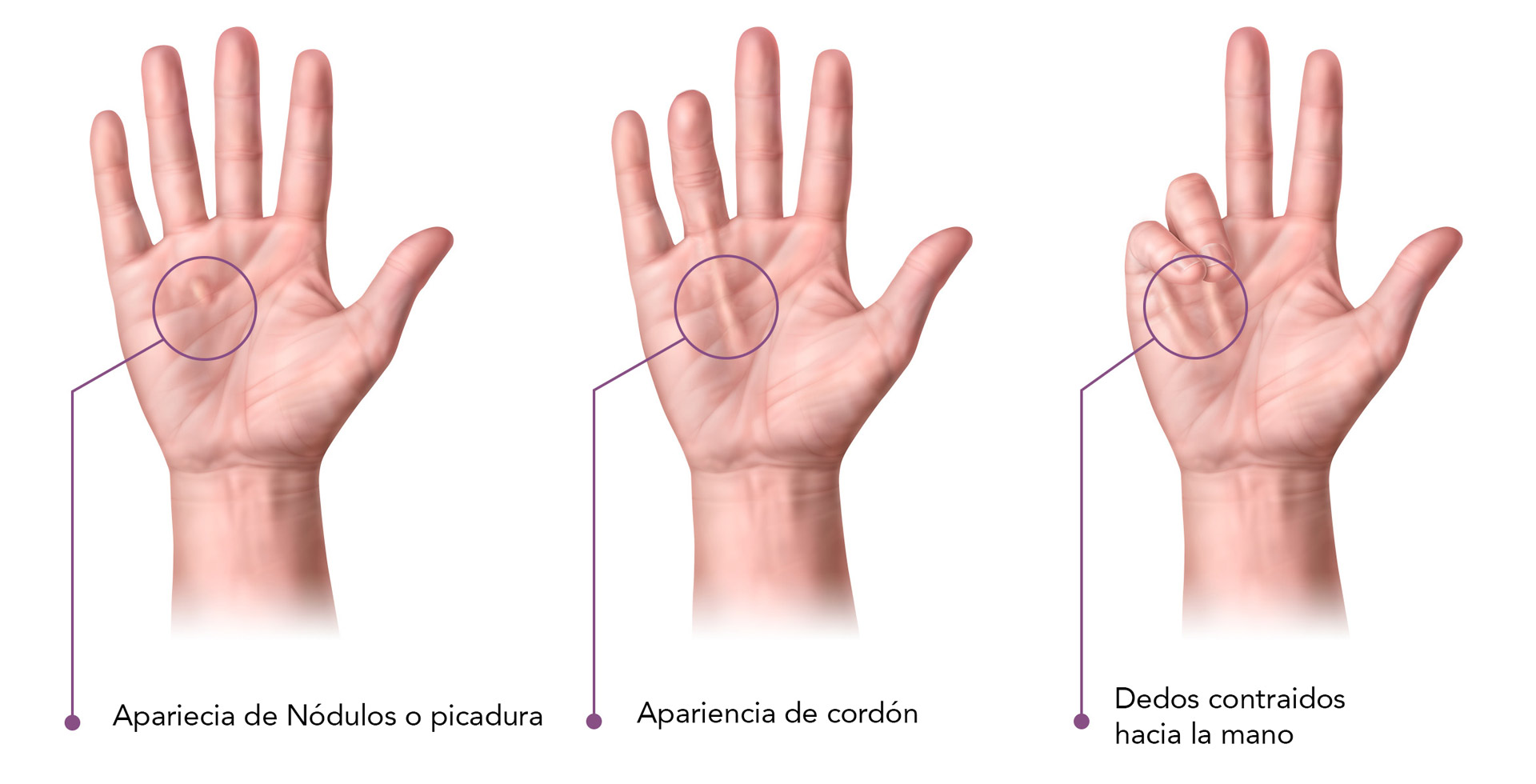 Dupuytren's disease - Corporis Fisioterapia - Marbella