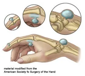 Ganglion Cysts Treatment | Mytien Goldberg, MD, FACS | Beverly Hills