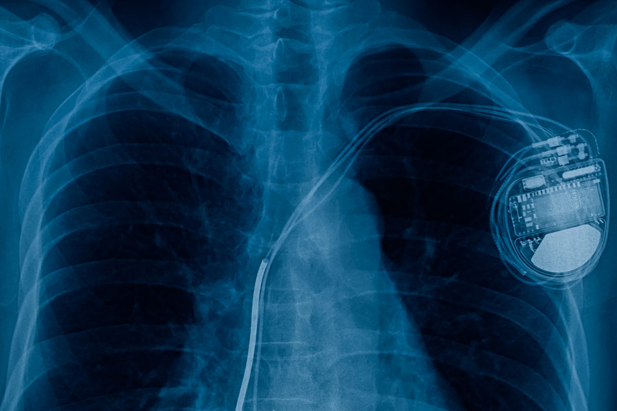 PACEMAKER vs 5G