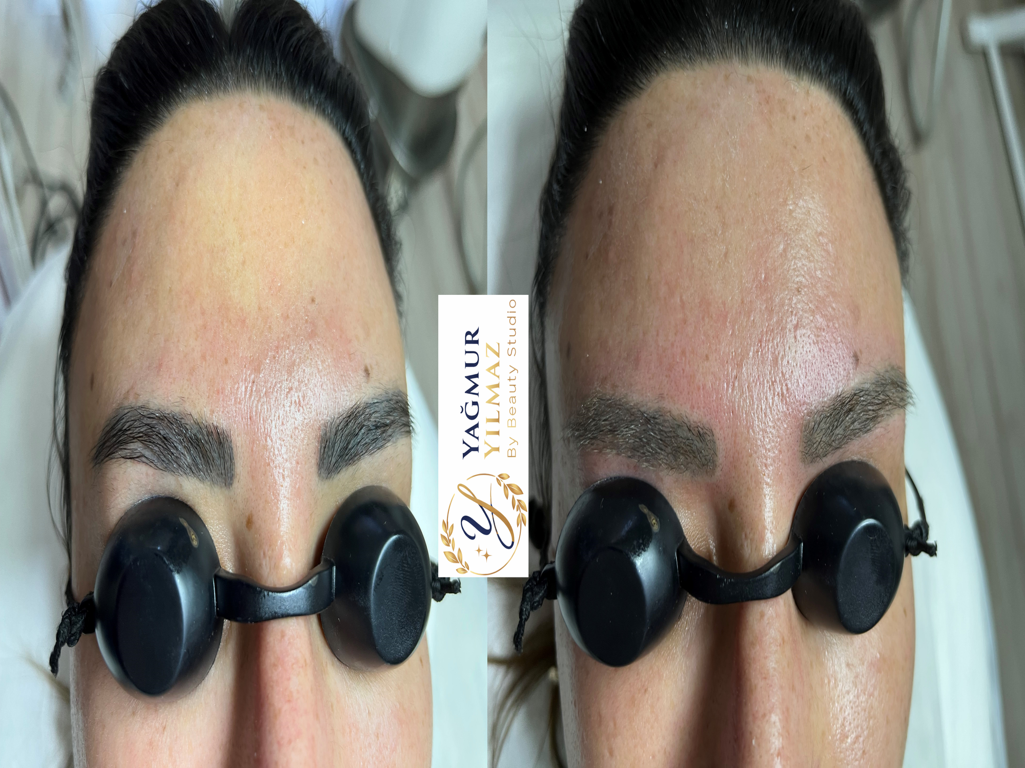 Pico lazer ile kaş silme