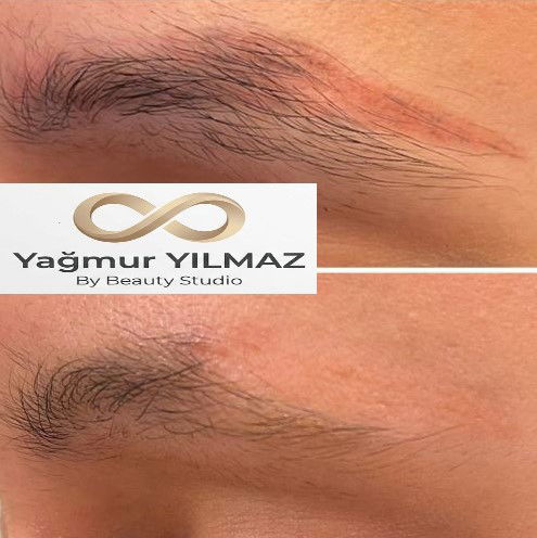 Ankara Kaş Sildirme