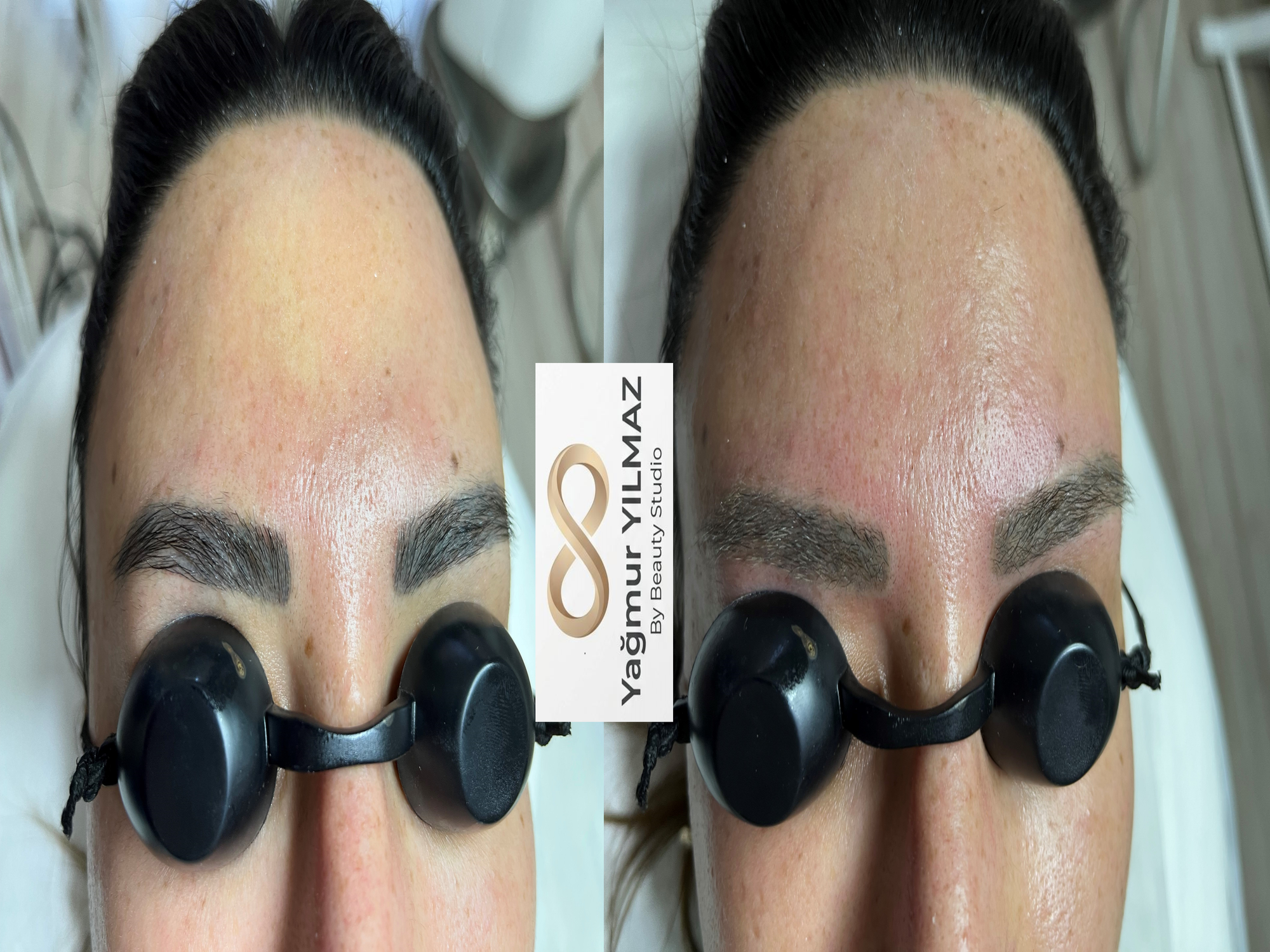 Pico lazer ile kaş silme