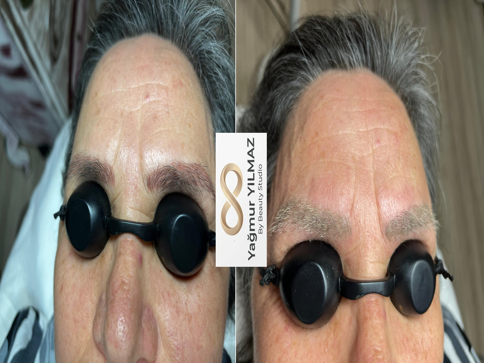 Eryaman Kaş Sildirme