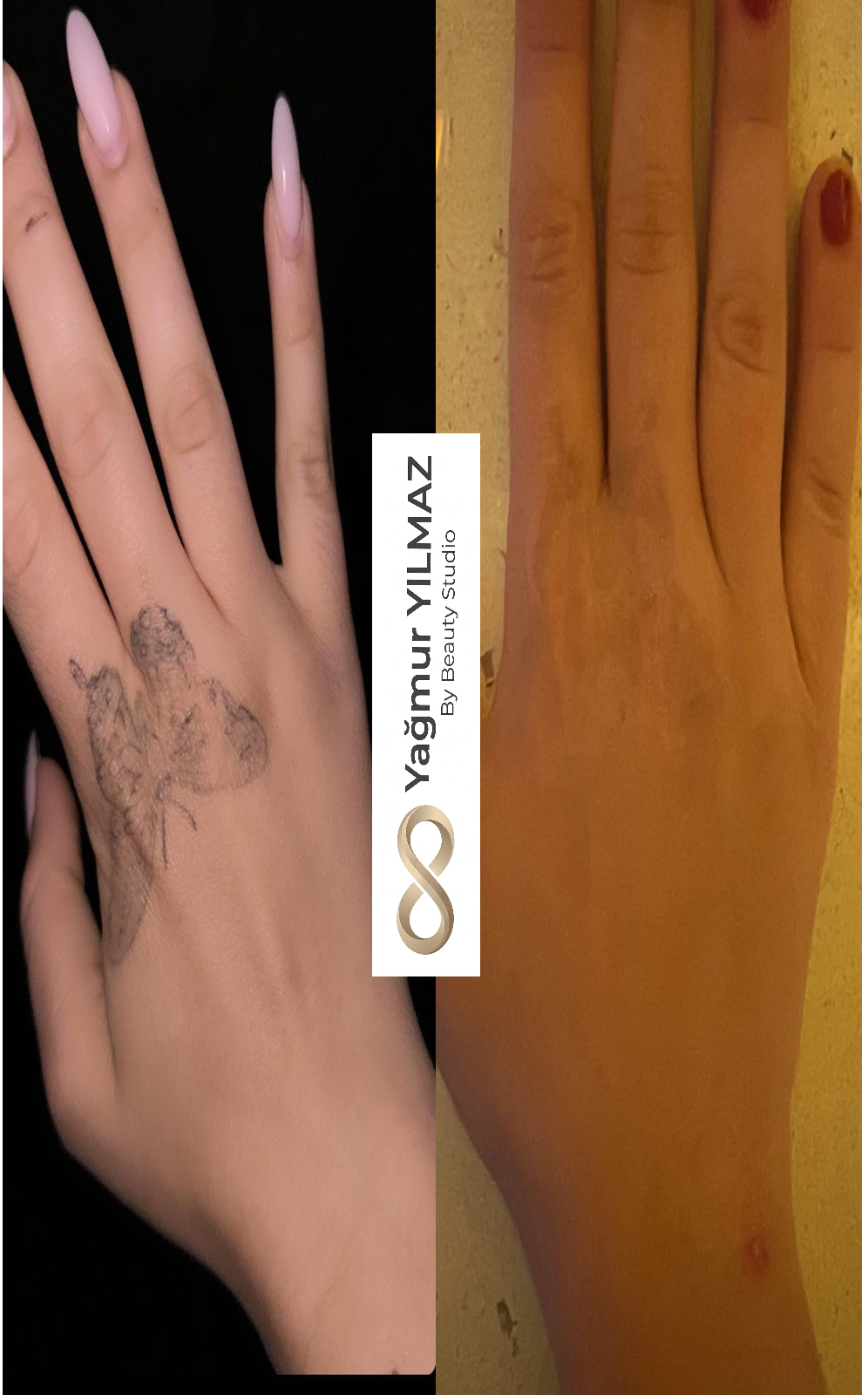 Ankara Dövme Silme Fiyatları