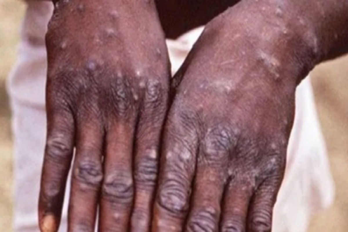 Monkey pox, une nouvelle maladie à Bangui