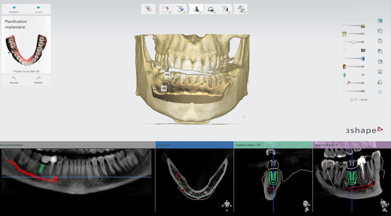 Planification Implantaire