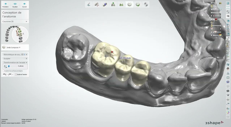 Conception de Prothèses Dentaires