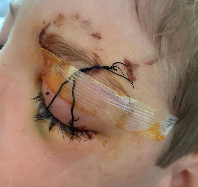 Les morsures canines