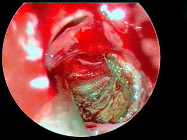 בחלק מהמקרים ישנו צורך בהתערבות כירורגית על מנת לנקות את גתות האף מרקמה מוגלתית פגועה.