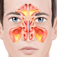 מבחינים בין שני סוגי סינוסיטיס: חריף וכרוני. ההבחנה בין שני הסוגים נעשית בעיקר על בסיס חישוב משך המחלה. דלקת הרירית יכולה לנבוע מזיהומים נגיפיים של דרכי הנשימה העליונות ו/או מאלרגיה. כתוצאה מכך מצטבר בגתות נוזל רירי המזדהם על ידי חיידקים שונים.