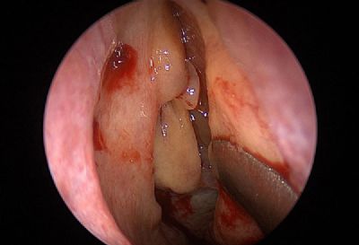 מחקרים מדעיים מראים שלכמות חלקיקי פטריות הנמצאים באוויר ובחלל האף קשר ישיר לחומרת הדלקת ברירית גתות האף.