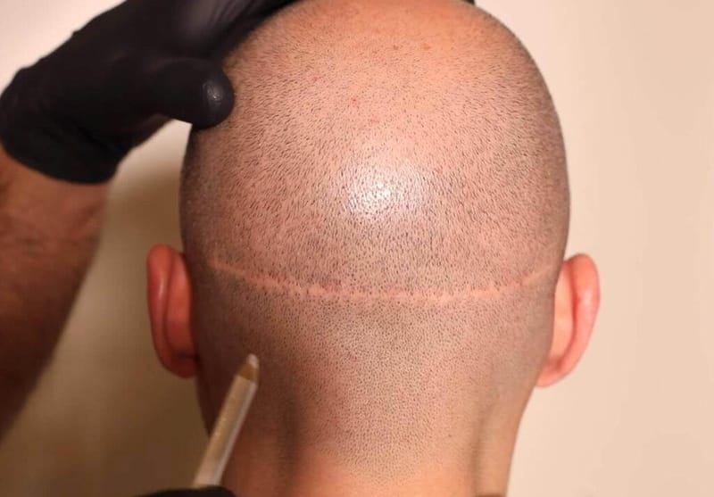 FUT Hair Transplant Turkey