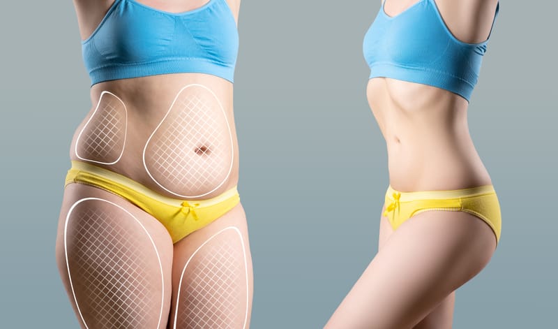 Liposuction