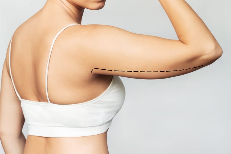 Arm Liposuction