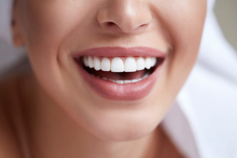 Emax Veneers