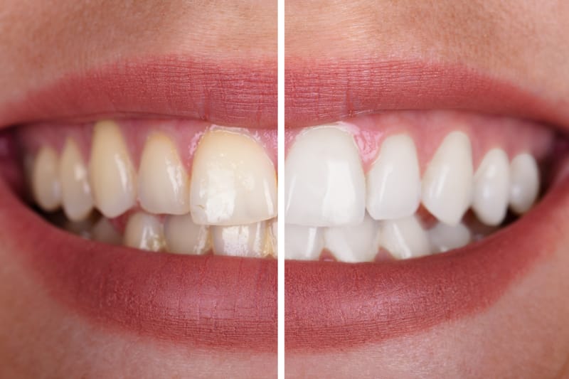 Teeth Whitening Dubai