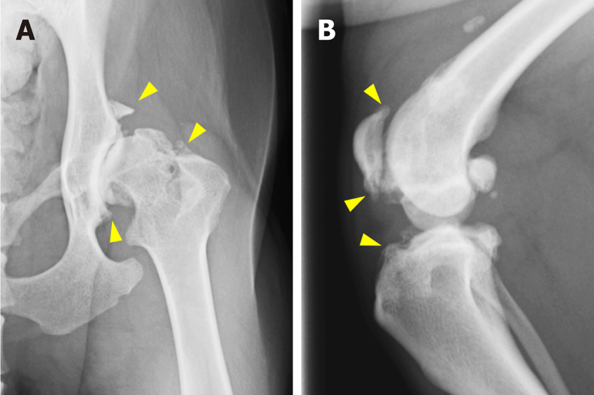 Arthrosis