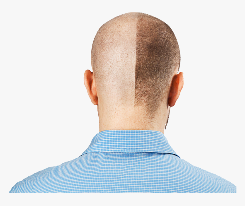 Hair transplantation