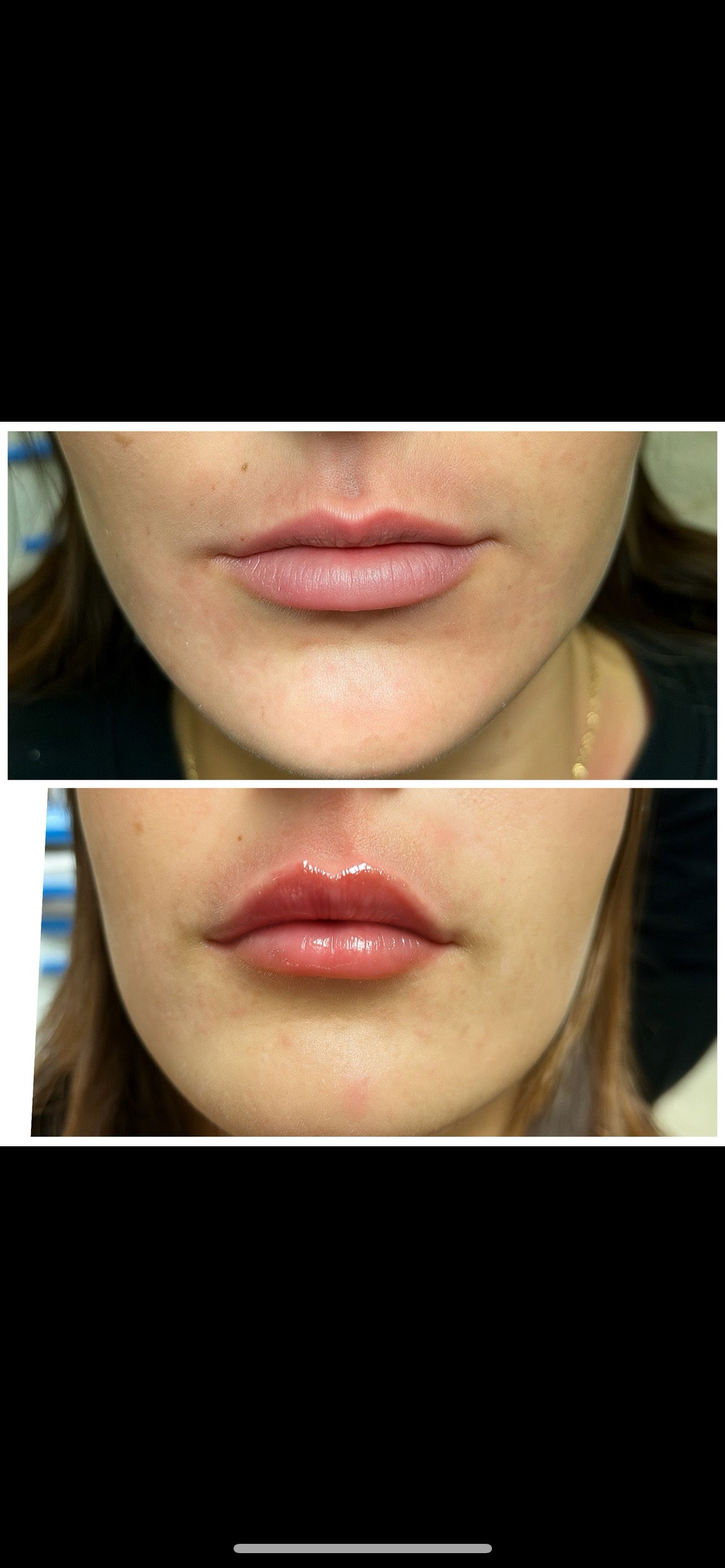 filler lips-medicina etstetica