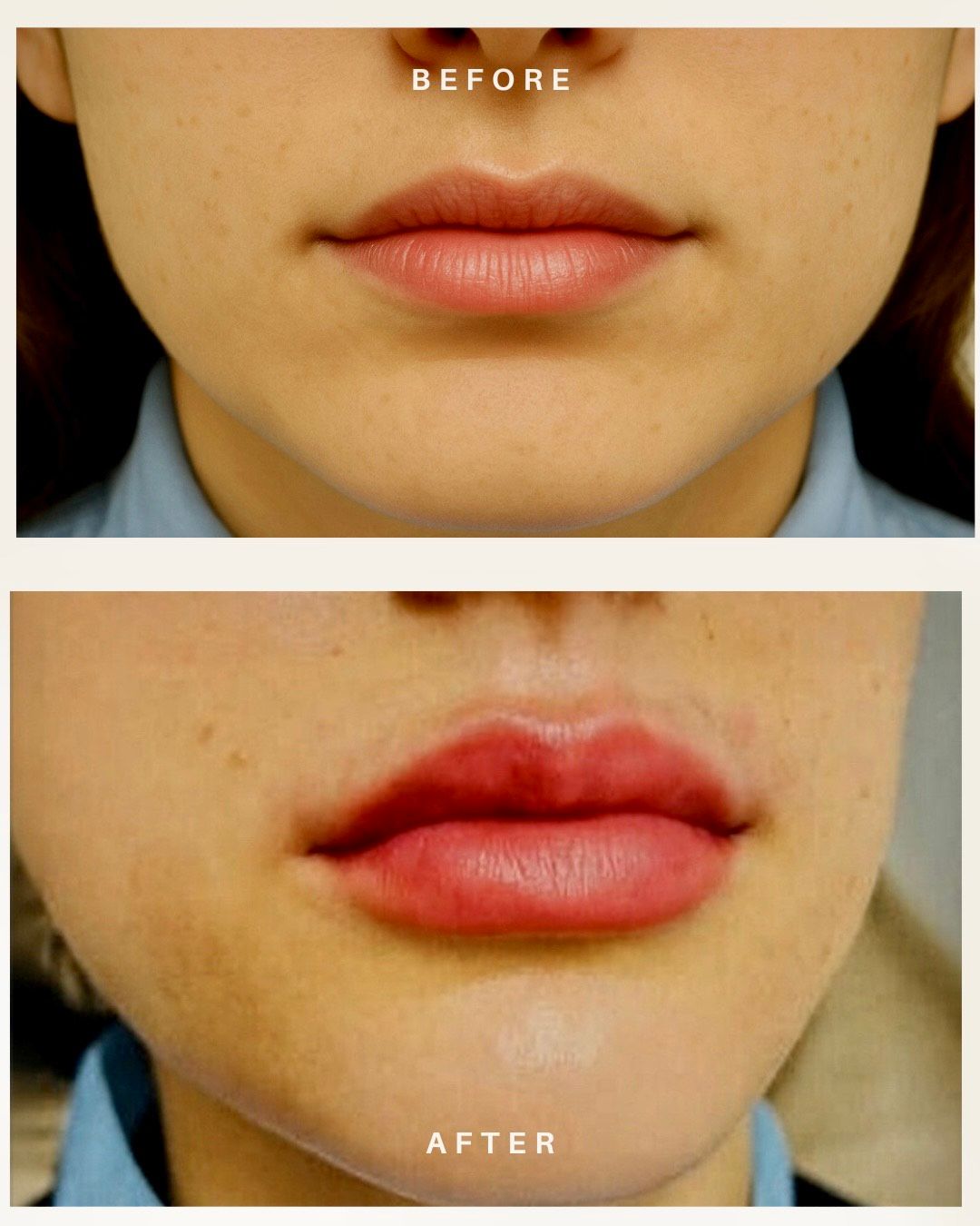 filler lips-medicina estetica