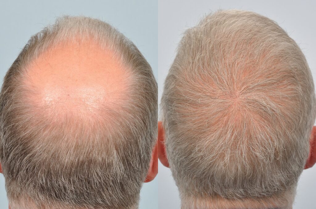 Hair Transplant vs. Wigs: Which Is Better?